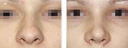 Hagymás orr, nazális rhinoplasty burgonya (burgonya orr) hagymás orr, orrplasztika az orr burgonya