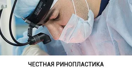 Hagymás orr, nazális rhinoplasty burgonya (burgonya orr) hagymás orr, orrplasztika az orr burgonya