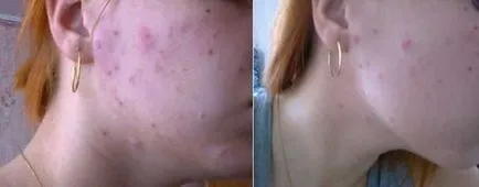 Áttekintés tabletták, gyógyszerek, kenőcsök pattanások (acne hormonális fotó) Áttekintés tabletták, gyógyszerek, kenőcsök akne