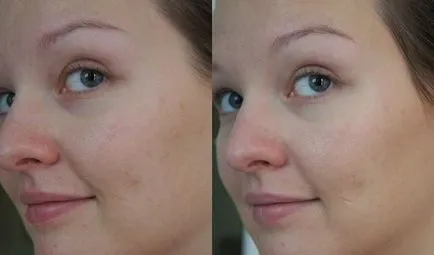 Áttekintés tabletták, gyógyszerek, kenőcsök pattanások (acne hormonális tabletták fotó) Áttekintés tabletták, gyógyszerek, kenőcsök akne