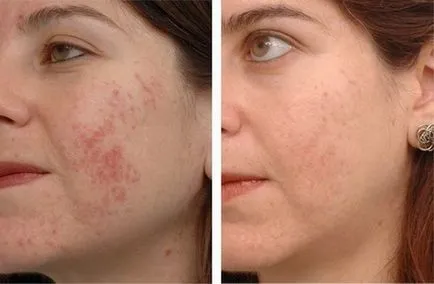 Áttekintés tabletták, gyógyszerek, kenőcsök pattanások (acne hormonális fotó) Áttekintés tabletták, gyógyszerek, kenőcsök akne