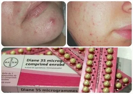 Áttekintés tabletták, gyógyszerek, kenőcsök pattanások (acne hormonális fotó) Áttekintés tabletták, gyógyszerek, kenőcsök akne