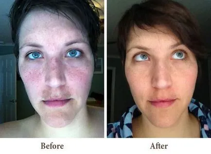 Áttekintés tabletták, gyógyszerek, kenőcsök pattanások (acne hormonális tabletták fotó) Áttekintés tabletták, gyógyszerek, kenőcsök akne