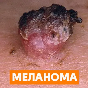 Anyajegy növekvő okokat, amelyek miatt az orvos kérni, hogyan kell eltávolítani