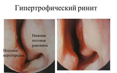 Rhinitis gyermekek tünetei és kezelése, az okok (gyermek) Rhinitis gyermekek tünetei és kezelése, okai