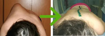 Műtét a gerinc scoliosis 3, 4 fok típusok, jelzések, különösen sebészeti (gerincferdülés) műtét a gerinc gerincferdülés 3, 4 fok típusok, jelzések, főleg sebészeti
