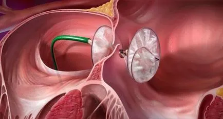 Nyitott foramen ovale, újszülöttek és csecsemők