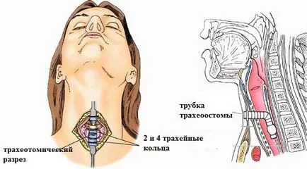duzzanat a torokban felnőttek és gyermekek okai és következményei