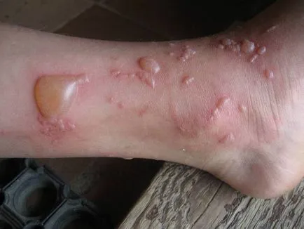 Burn egy gyerek - mit kell tennie a szülők és milyen veszélyes (mit kell tenni, ha a gyermek a forró vizet ég 2 fok hólyagokkal vas kenőcs elsősegély mint kend hőkezelés) Burn a gyermek - a szülők, hogy mit és mennyit ez veszélyes