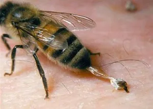 Elsősegély a méh fullánkja, megszüntetve ödéma és duzzanat, vagy ártalom egy szúrás allergia (eltávolítás) Elsősegély a méh fullánkja, megszüntetve ödéma és duzzanat, vagy ártalom egy szúrás allergia