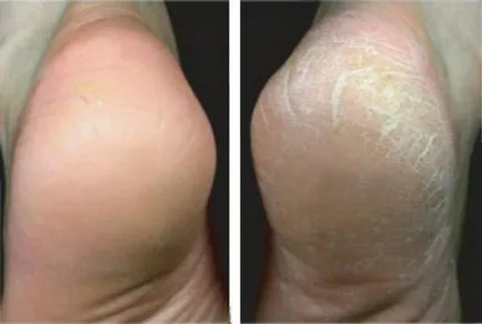 Foot peeling technológia és típusok