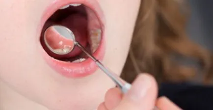 Miért fáj az alsó ajak és az ajak belső, fájó szája sarka