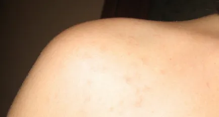 Miért kapok egy kiütés a váll és a hát, bőrbetegségek