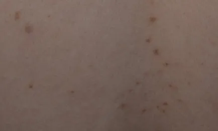 Miért kapok egy kiütés a váll és a hát, bőrbetegségek