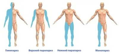 A következmények a stroke az idősek és kiújulásának megelőzésére az idősebb emberek 80 év után (stroke) A következmények a stroke az idősek és kiújulásának megelőzésére az idősebb emberek 80 év után