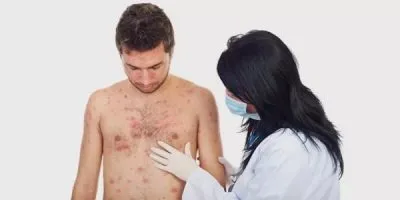 Voltak piros foltok a testen, és okoz viszketés és bőrpír viszketés, hogyan kell kezelni (meg) Voltak piros foltok a testen, és okoz viszketés és bőrpír viszketés, hogyan kell kezelni