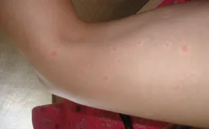 A megjelenése vörös foltok a bőrön okait és allergia kezelésére, viszkető foltok, miért, fotók (bőr) A megjelenése vörös foltok a bőrön okait és allergia kezelésére, viszkető foltok, miért, fotók
