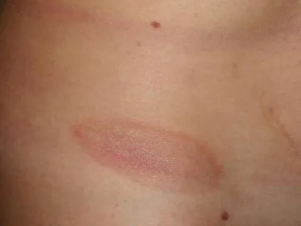 A megjelenése vörös foltok a bőrön okoz és allergia kezelésére, viszkető foltok, miért, fotó (megjelenés) A megjelenése vörös foltok a bőrön okait és allergia kezelésére, viszkető foltok, miért, fotók