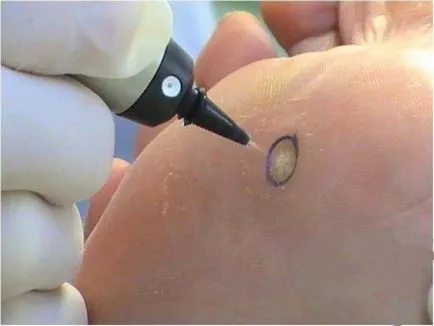 Kauterezés szemölcsök folyékony nitrogénnel (moxibustion) Kauterezés szemölcsök folyékony nitrogénnel