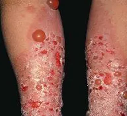 Pemphigus - okai, tünetei, diagnózis és kezelés (ok) Pemphigus - okai, tünetei, diagnózisa és kezelése