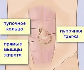 Köldöksérv műtéti eltávolítása