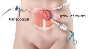 Köldöksérv műtéti eltávolítása