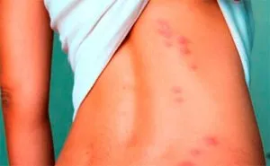 A foltok vagy vörös, viszkető -, hogy lehet (spot) A foltok vagy vörös, viszkető -, hogy lehet
