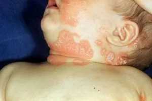 Psoriasis gyermekek okoz, a tünetek, a kezelés, és a fényképek (psoriasis) Psoriasis gyermekeknél okoz, tünetei, kezelése, és a fotók