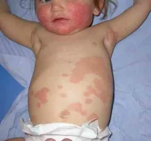 Psoriasis gyermekeknél okoz, tünetei, kezelése és a fotó (gyermek) Psoriasis gyermekeknél okoz, tünetei, kezelése, és a fotók