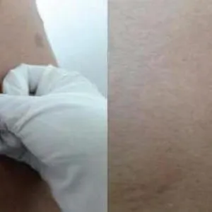 Pemphigus felnőtteknél