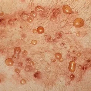 Pemphigus felnőtteknél