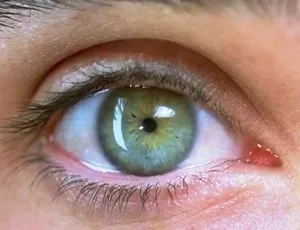 Mydriasis - az okok, amely bővíthető a tanulók