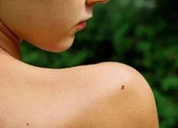 seborrheás keratosis