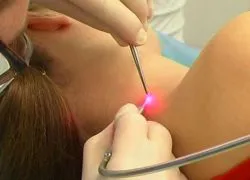 seborrheás keratosis