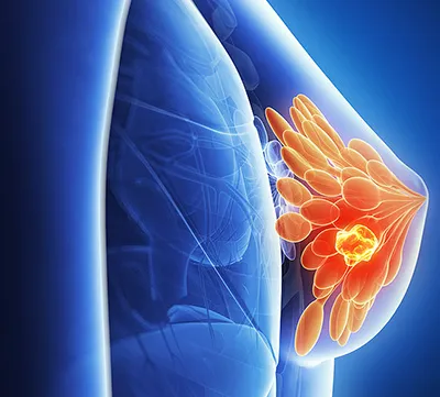 Sarcoma a mell, hogy ez, a tünetek és a mellrák kezelésére nőkben (emlő) Sarcoma a mell, hogy ez, a tünetek és a kezelés a mellrák a nők