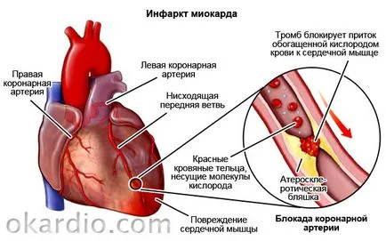 Egy szívroham okoz, tünetei, és mit kell tenni kezelés (támadás) Egy szívroham okoz, tünetei, kezelése és mit kell tenni