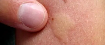Csapok okai az emberi test, hogyan kell kezelni, diagnózis (fő) Tölcsérek az emberi szervezetben okoz, hogyan kell gyógyítani, diagnózis