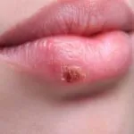 A kiütés az újszülöttkori osztályozására, kezelésére, veszély (kiütés) A kiütés az újszülöttkori osztályozására, kezelésére, veszély