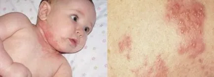 A kiütés az újszülöttkori osztályozására, kezelésére, veszély (veszély) A kiütés az újszülöttkori osztályozására, kezelésére, veszély