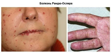 Zúzódások ok nélkül a nők és férfiak okoz, kezelés