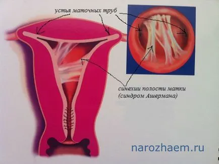 Összenövések a méhben tünetek és problémák kezelését a férfi és női terméketlenség és módszerek oldatuk