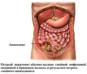 A hőmérséklet alatt és után appendectomia kezelés (kezelés) A hőmérséklet alatt és a kezelés után appendectomia