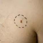 Mi történik, ha egy anyajegy ledönteni Mi történik, ha egy anyajegy ledönteni