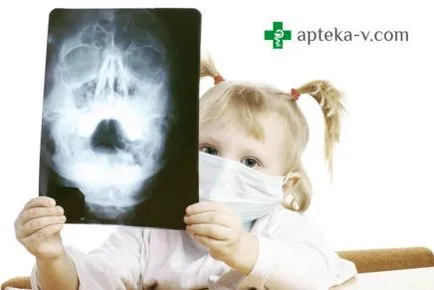 Hogyan kell kezelni a torokfájás a gyermek
