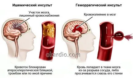 Minden a tüneteket, a stroke és az első jelei a teljes felülvizsgálat (jelek) Minden a tüneteket, a stroke és az első jelei a teljes felülvizsgálat