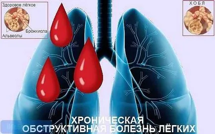 A krónikus obstruktív tüdőbetegség kezelésére (betegség) A krónikus obstruktív tüdőbetegség kezelésére