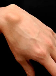 Wen a karon okok, tünetek és a kezelés (oka) Wen a karon okoz, tünetek és a kezelés