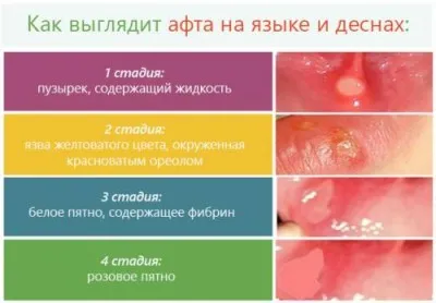 Afta száj azok okait és a kezelés (afta) Afta a szájban, mint azok okait és kezelési