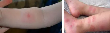 Allergia rovarcsípések bolhák, szúnyogok és poloska, kezelésére felnőttek és gyermekek, fotó falatok (tünetek) Allergia rovarcsípések bolhák, szúnyogok és poloska, kezelésére felnőttek és gyermekek, fotó falatok