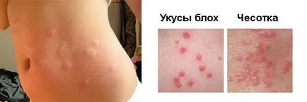 Allergia bolha csípése a rovarok, szúnyogok és poloska, kezelésére felnőttek és gyermekek, fotó falatok (marás) Allergia rovarcsípések bolhák, szúnyogok és poloska, kezelésére felnőttek és gyermekek, fotó falatok